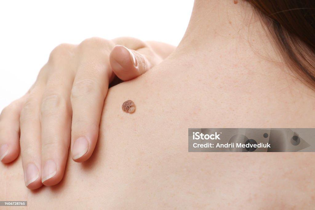 Eliminación de Verrugas en Clínica Vytalya Pachuca